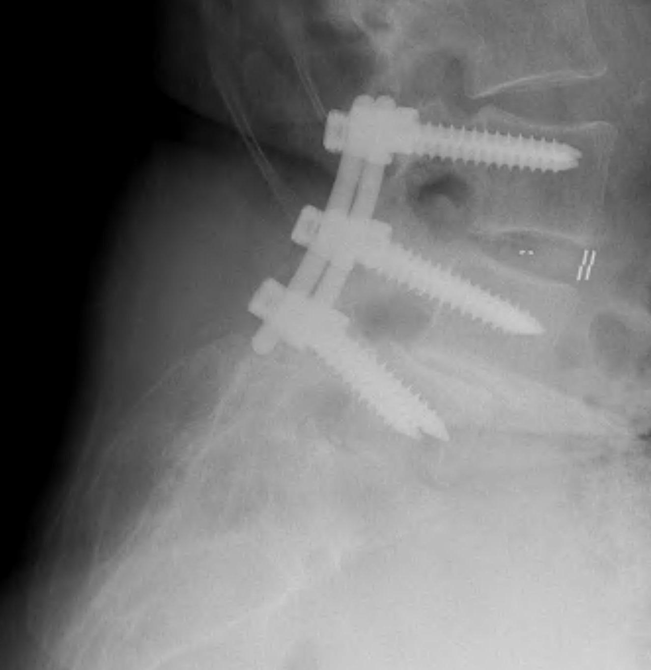 Degenerative Spondylolithesis PLF